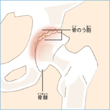 進行期