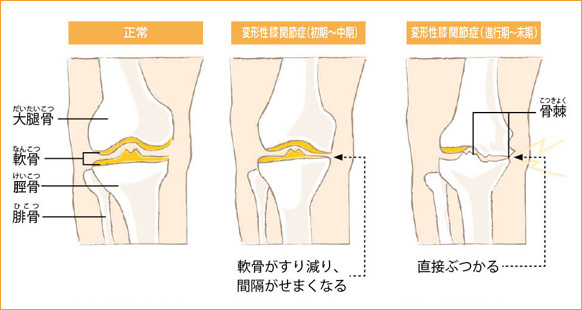 変形性ひざ関節症